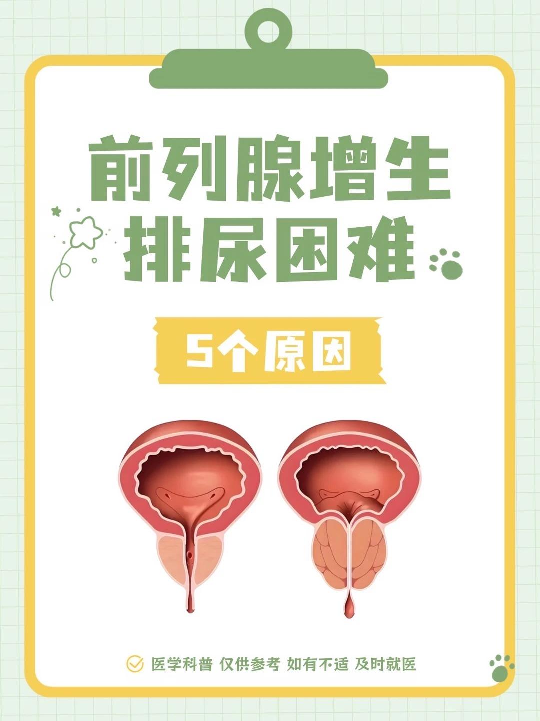 前列腺增生伴随排尿困难，男性可以自查这5个诱因