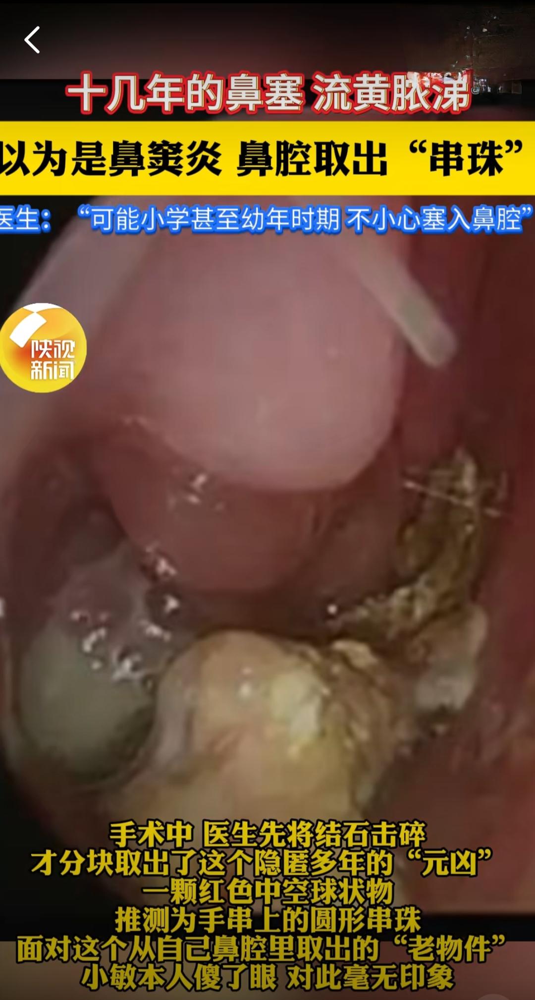 18岁的姑娘小敏，被鼻塞流脓的毛病折磨了十多年，一直以为是顽固的鼻窦炎。这些年只