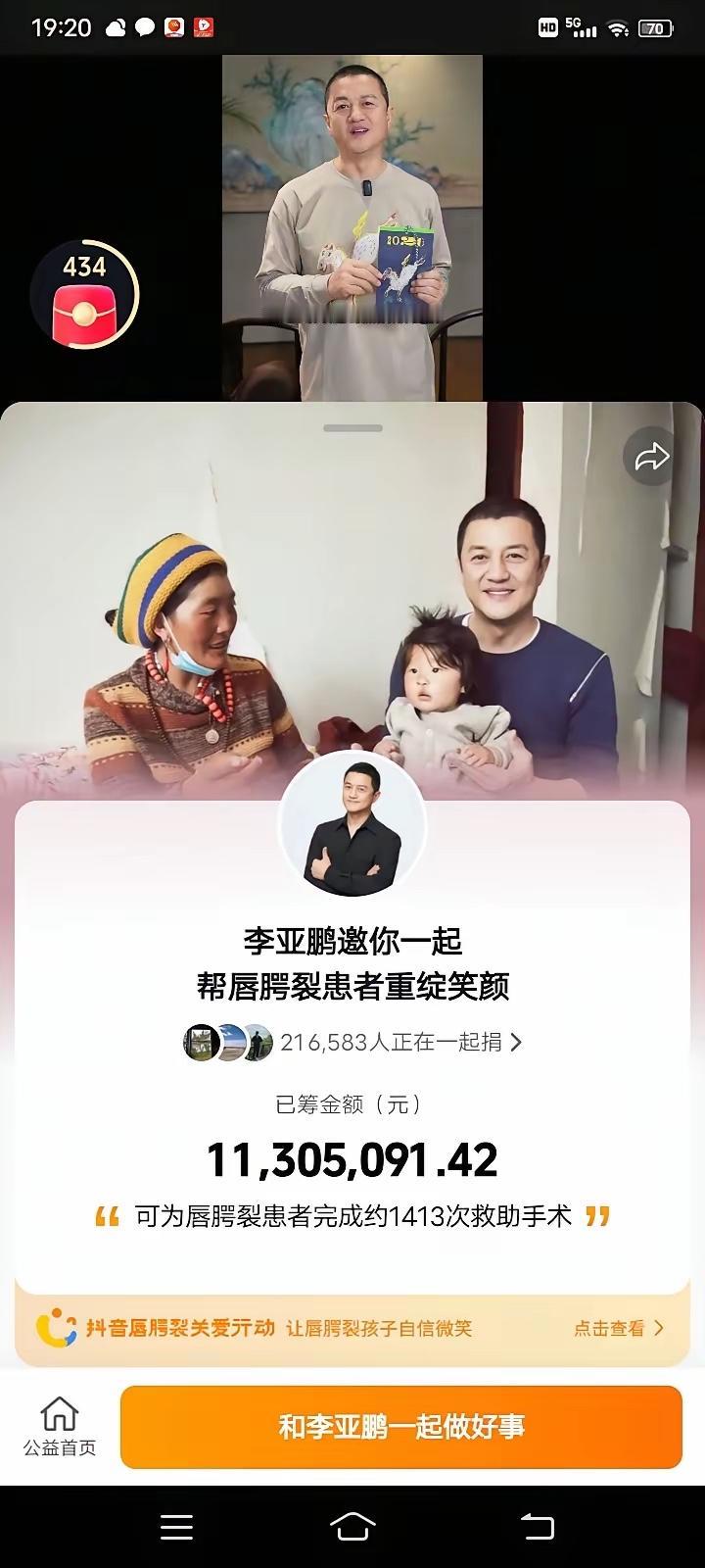 很早就听说李亚鹏嫣然基金是真的免费给兔唇小孩动手术，这几天李亚鹏他们基金医院据说
