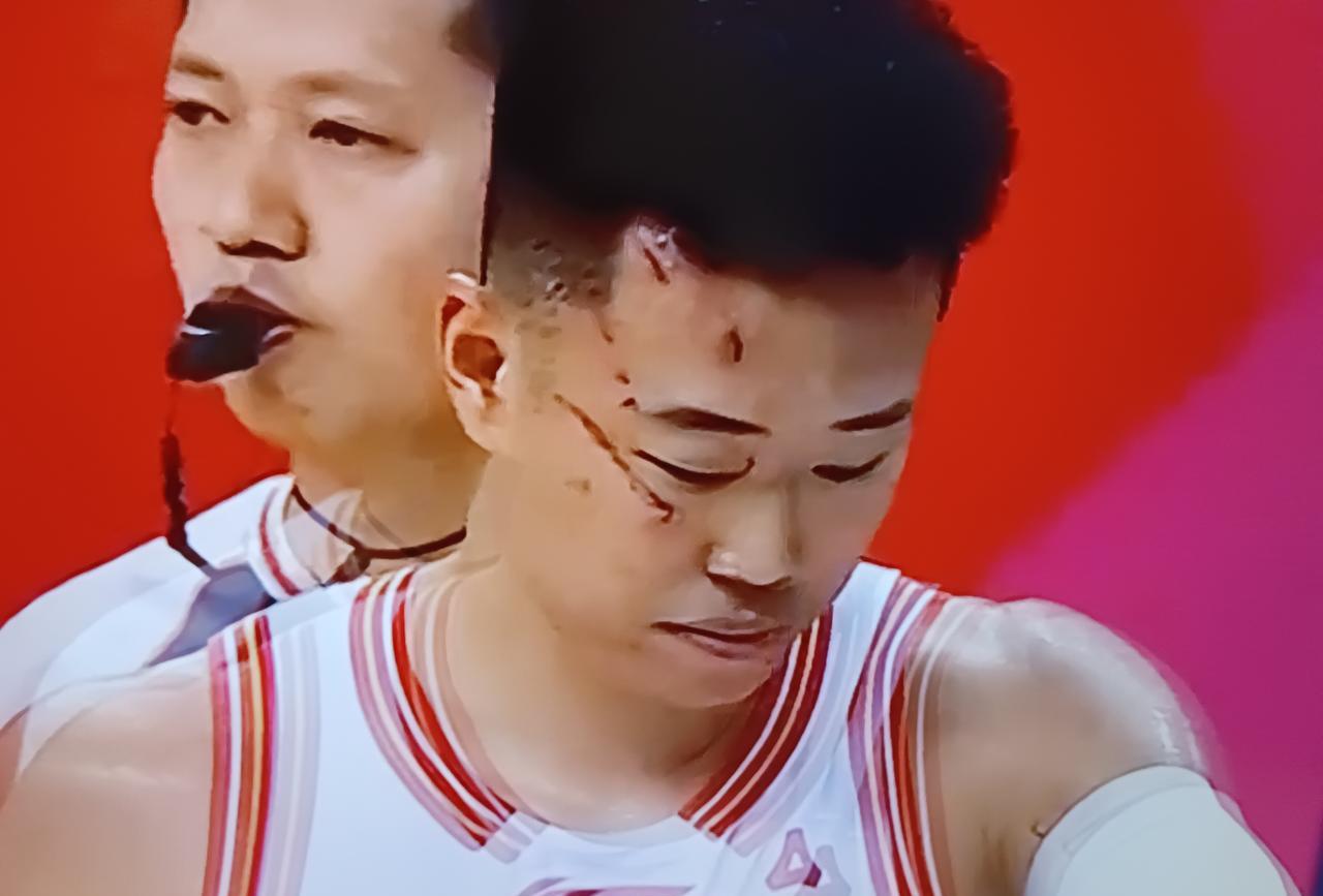 贺希宁昨天下飞机，脸疑似被青岛的海鸥给挠了，满脸抓痕，也多少影响了发挥。不过看看