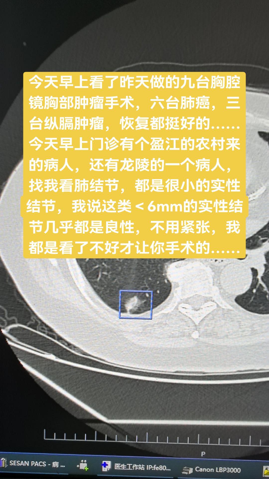 今天早上看了昨天做的九台胸腔镜胸部肿瘤手术，六台肺癌，三台纵膈肿瘤，恢...