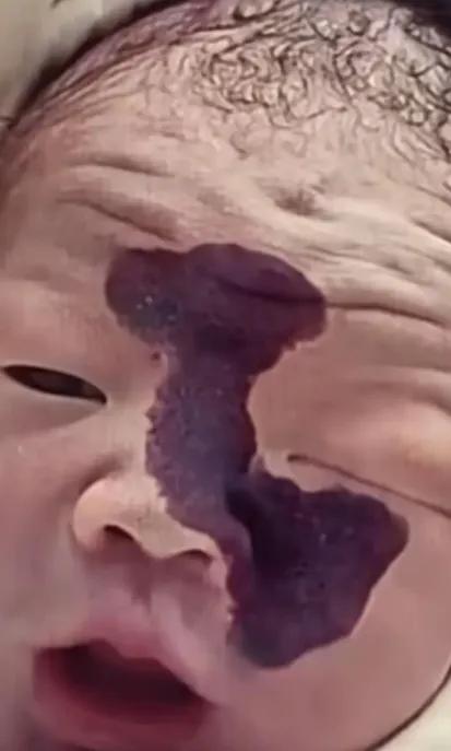 胎记下的抉择：丈夫的抛弃与母亲的坚守