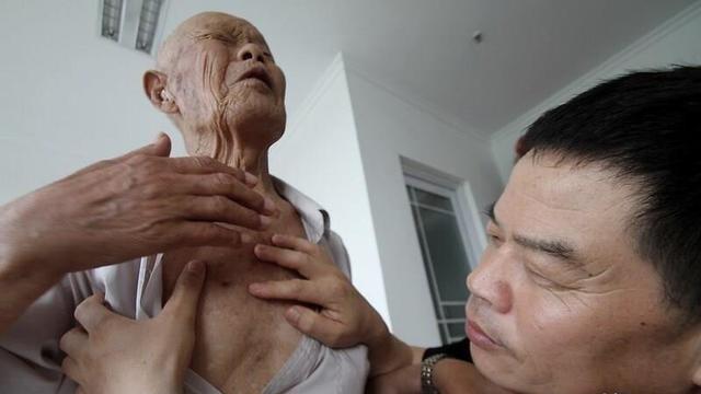 1956年，山东35岁农民，咳嗽10年，不肯就医。一天，他突然咳出一个黑色带血的