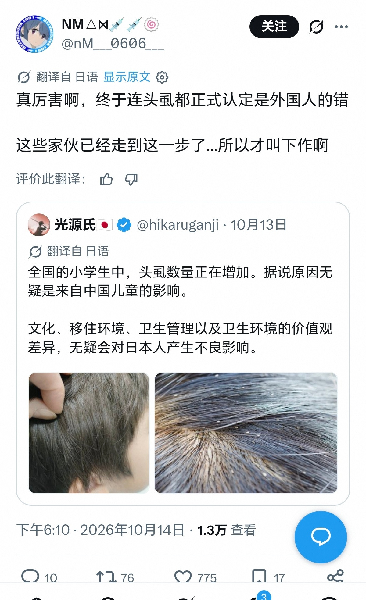 日本人真是疯了，日本儿童长头虱都要怪中国人………………​​​