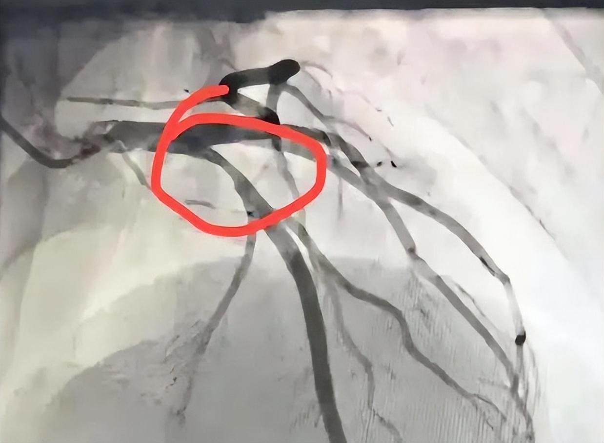 血管堵没堵，一个检查，既简单又便宜，通血管的最佳方法血管这个东西，平时感觉不