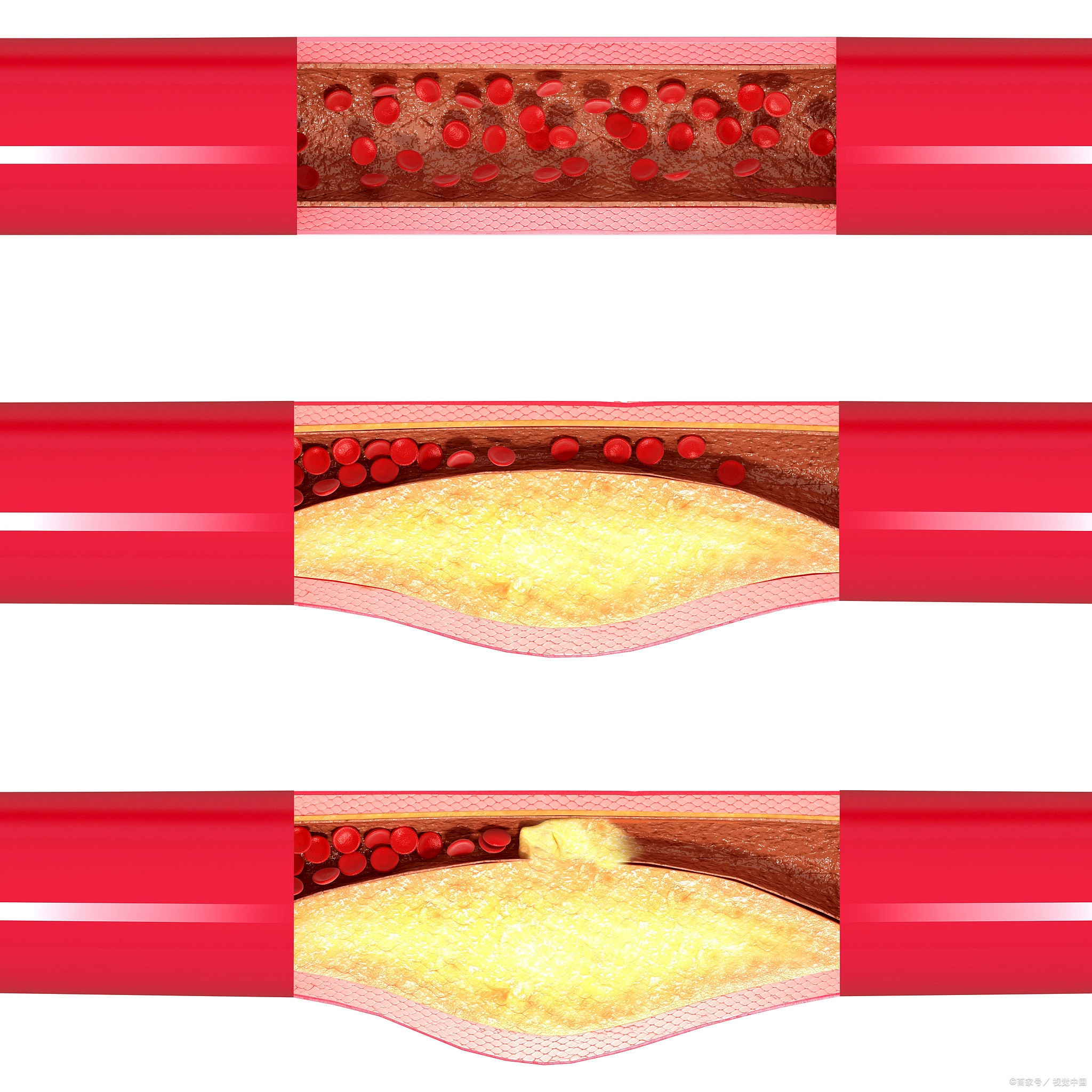 国际期刊刊登心梗防治中国方案什么是动脉粥样硬化？简单说：你的血管内壁，本来是光滑