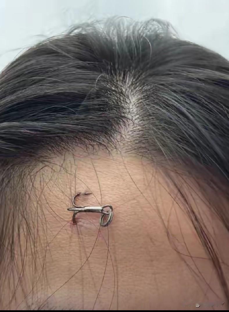 真可怕，男子第一次钓鱼就钓到了一个美女，美女要去医院，男子却觉得自己可以拔下来！
