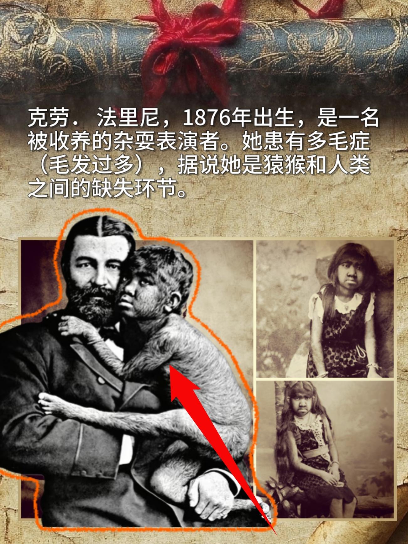 克劳。法里尼，1876年出生，是一名被收养的杂耍表演者。她患有多毛症...