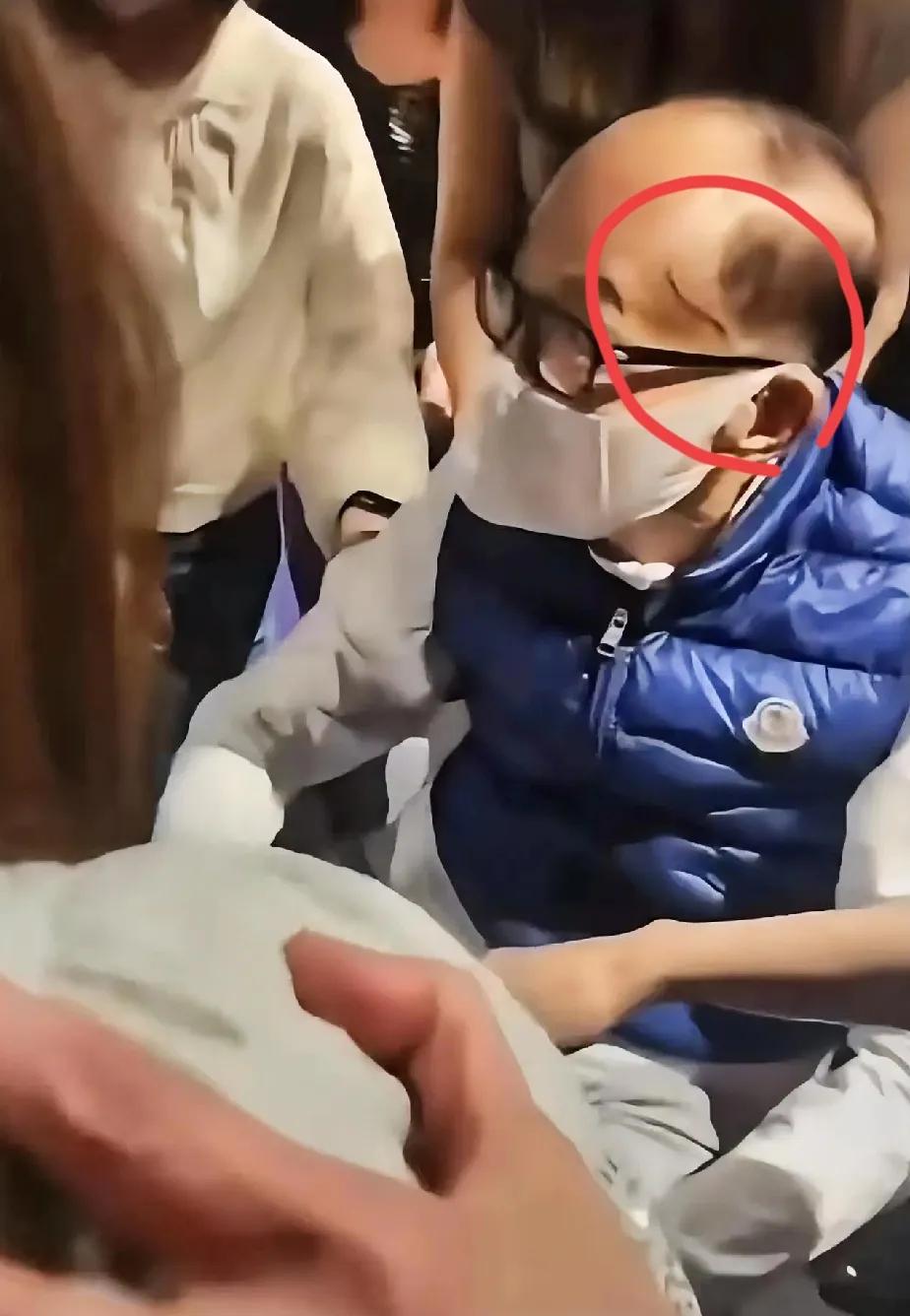 李嘉诚头上是什么东西？蚯蚓一样的，这么长一条，看着也不像疤痕。