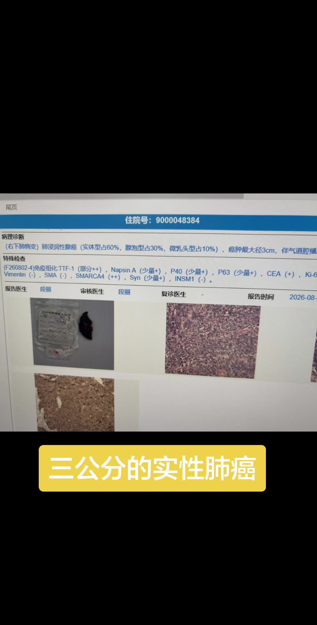三公分的实性肺癌，系统性的清扫淋巴结，第7.8组淋巴结阳性，N2阳性...