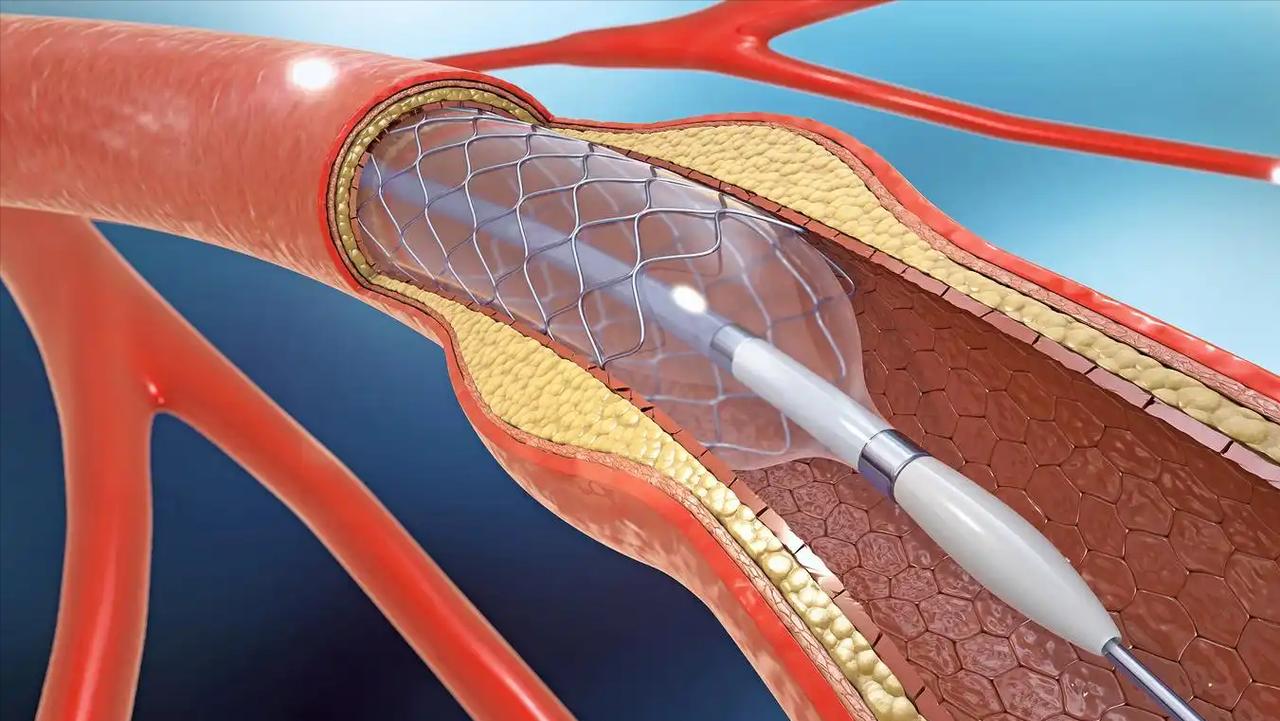 一个63岁的老陈，心脏放了两个支架，术后一切恢复得不错。可才过了半年，他在朋友聚