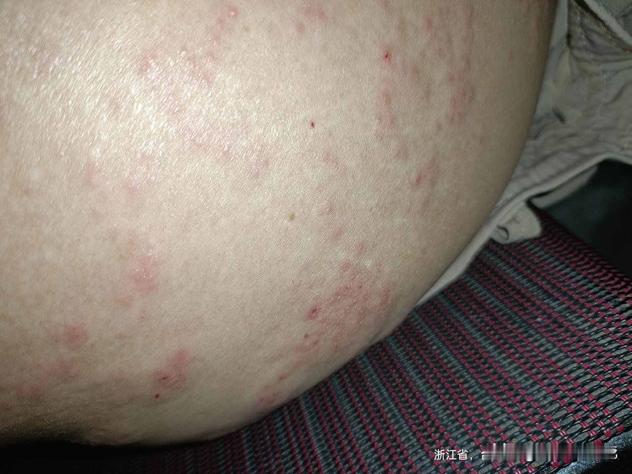 今天确认说带状疱疹，今天去挂针，昨天还是水泡，今天痒起来，想抓，抓了又有痛，