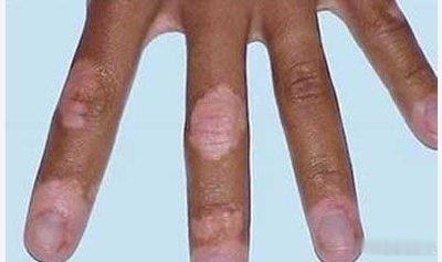 Nature子刊：白癜风可降低癌症风险！11月3日，发表在NatureCom