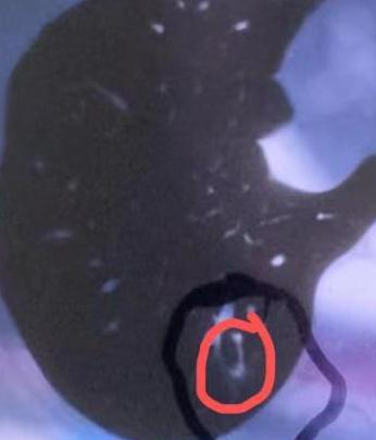 3个月前门诊遇到一位30岁的女士，由她先生陪着来的。她手里拿着外院的CT报告，声