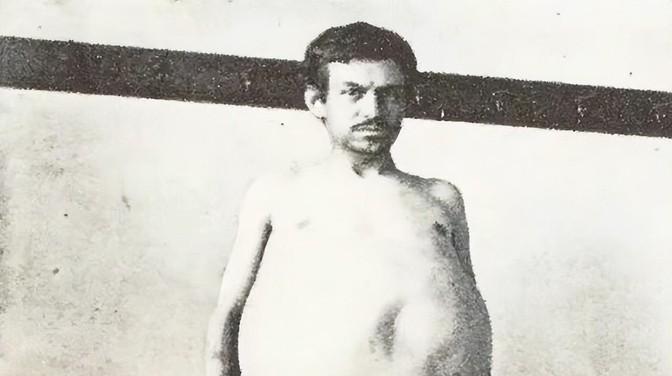 1940年，一位美国男子正在排泄大便时突然死亡，当法医检查过后发现男子体内竟然堆