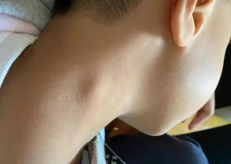 淋巴癌一查就是晚期？其实皮肤早有提示！若有5种表现，尽早筛查淋巴瘤被发现就是