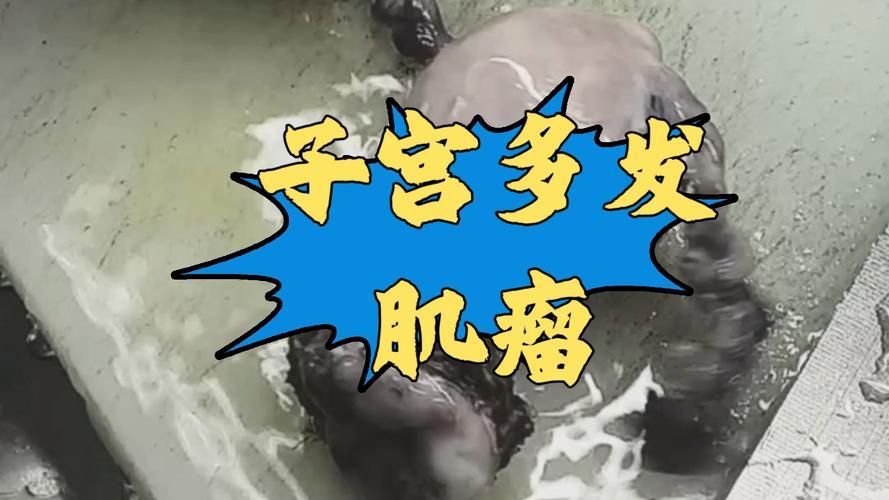 例假“渡劫”，竟揪出11cm肌瘤女子每次来例假都痛苦不堪，如渡劫般煎熬，腹痛