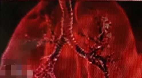 总以为肺结节是抽烟喝酒闹的，其实真正的源头另有其“人”。很多研究发现，肺结节的头