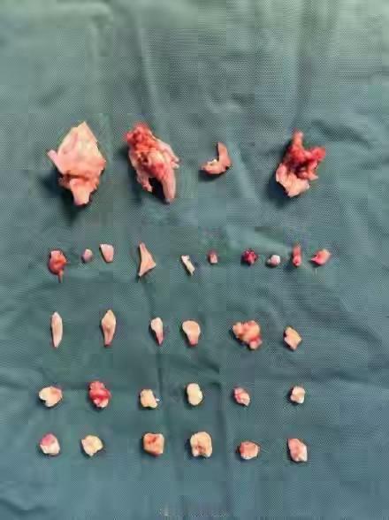 18岁少女肚里竟藏着“畸形婴儿”？24颗牙的真相，撕开了我们对身体的傲慢！