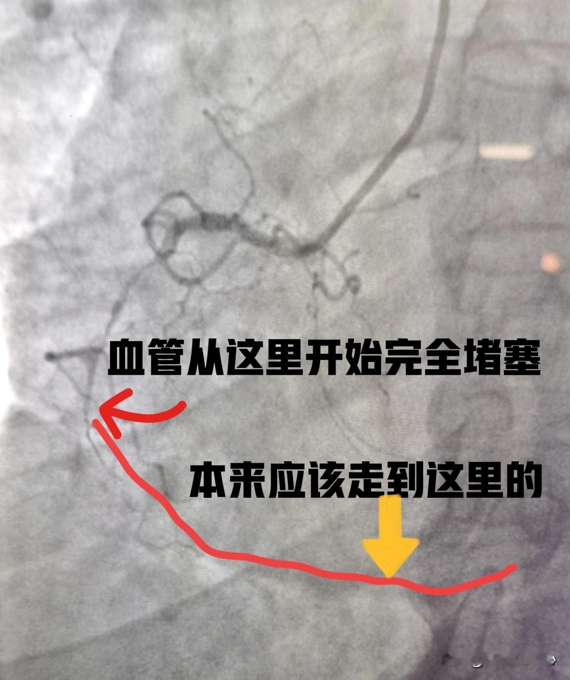 来！直观感受一下硝酸甘油对心脏血管的扩管作用，血流一下子通畅了。这是一个53岁