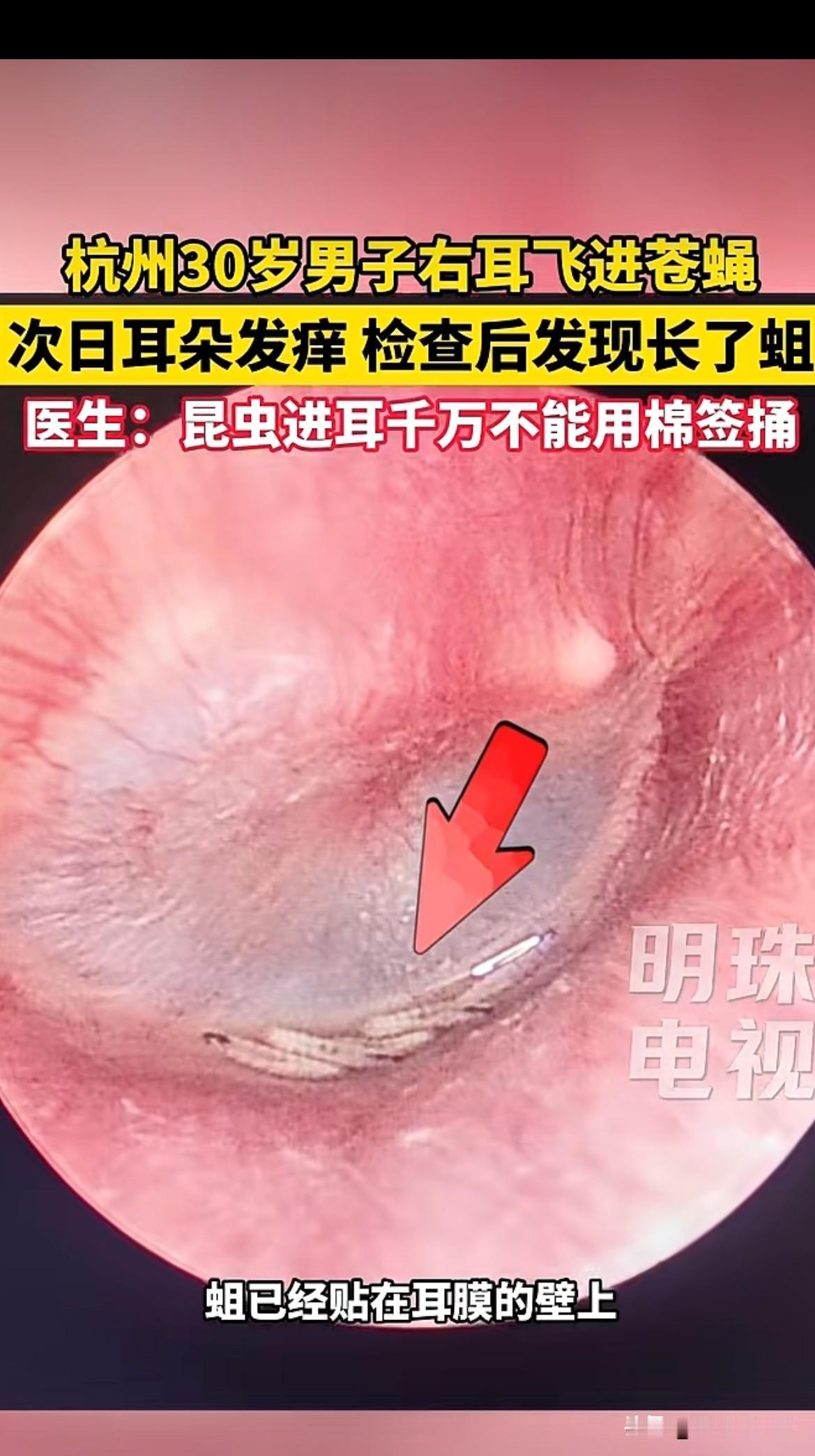 太吓人了，杭州一30岁男子右耳朵飞进去一只苍蝇，他用棉签捅了几下后感觉苍蝇在里面