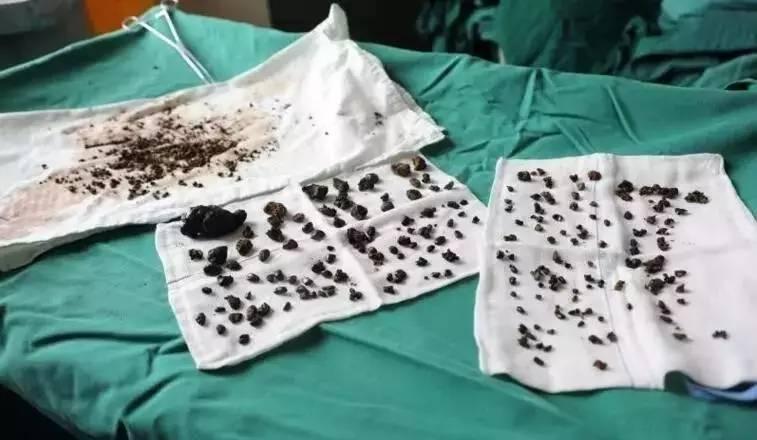 肾结石是怎么形成的？其实，肾结石的产生是一个逐步积累的过程。我们的肾脏负责过滤血