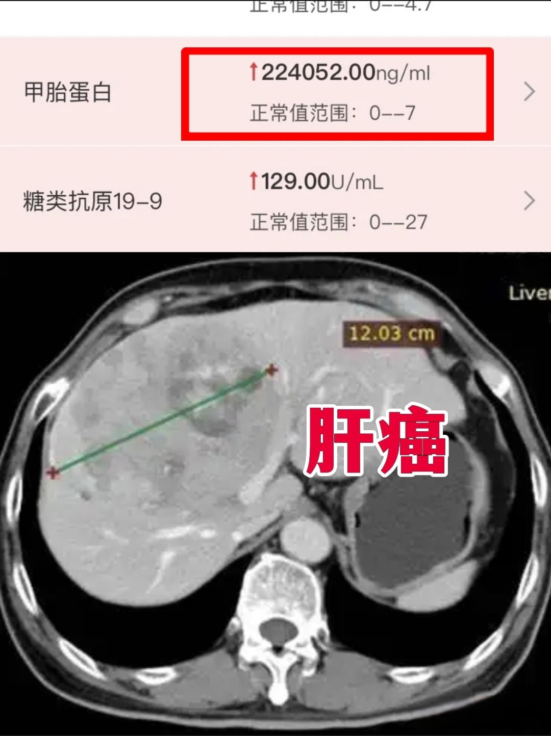 甲胎蛋白22万！简直是瘤子上长了肝。今天门诊来的一位山东淄博的肝癌患者...