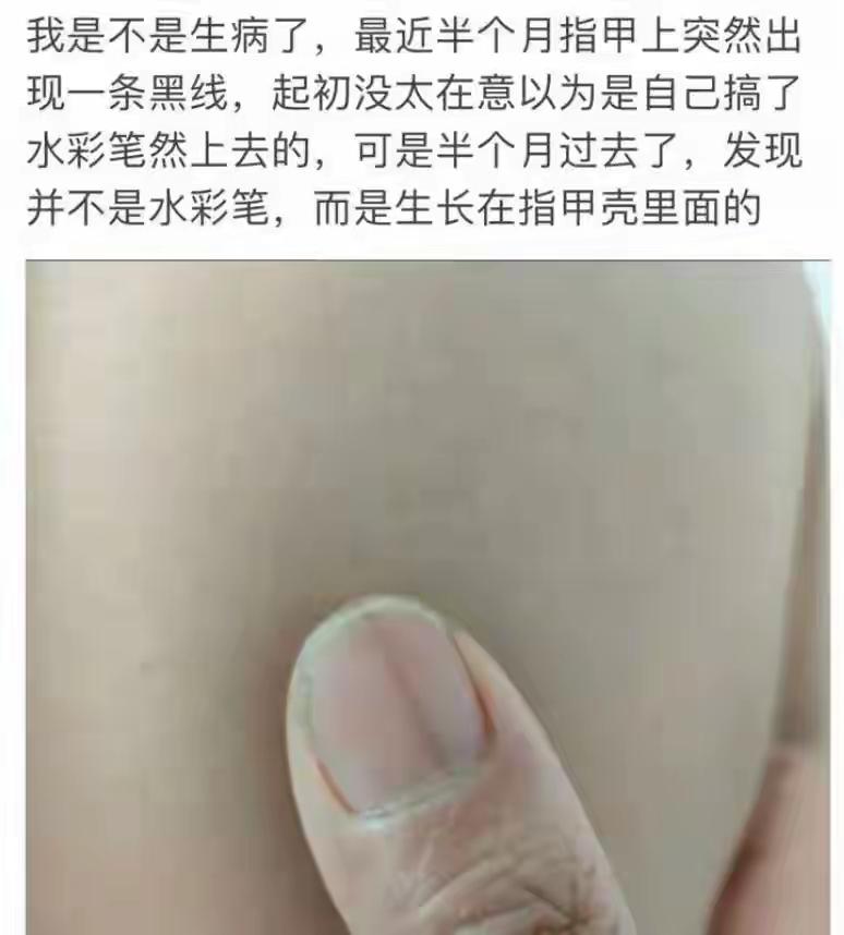 医生提醒：指甲出现这个变化，可能是癌变！别不当回事！剪指甲时，你有没有突