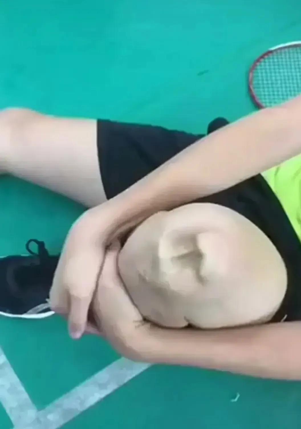 天哪，我一个朋友打羽毛球，膝盖摔成这种，还有救吗？