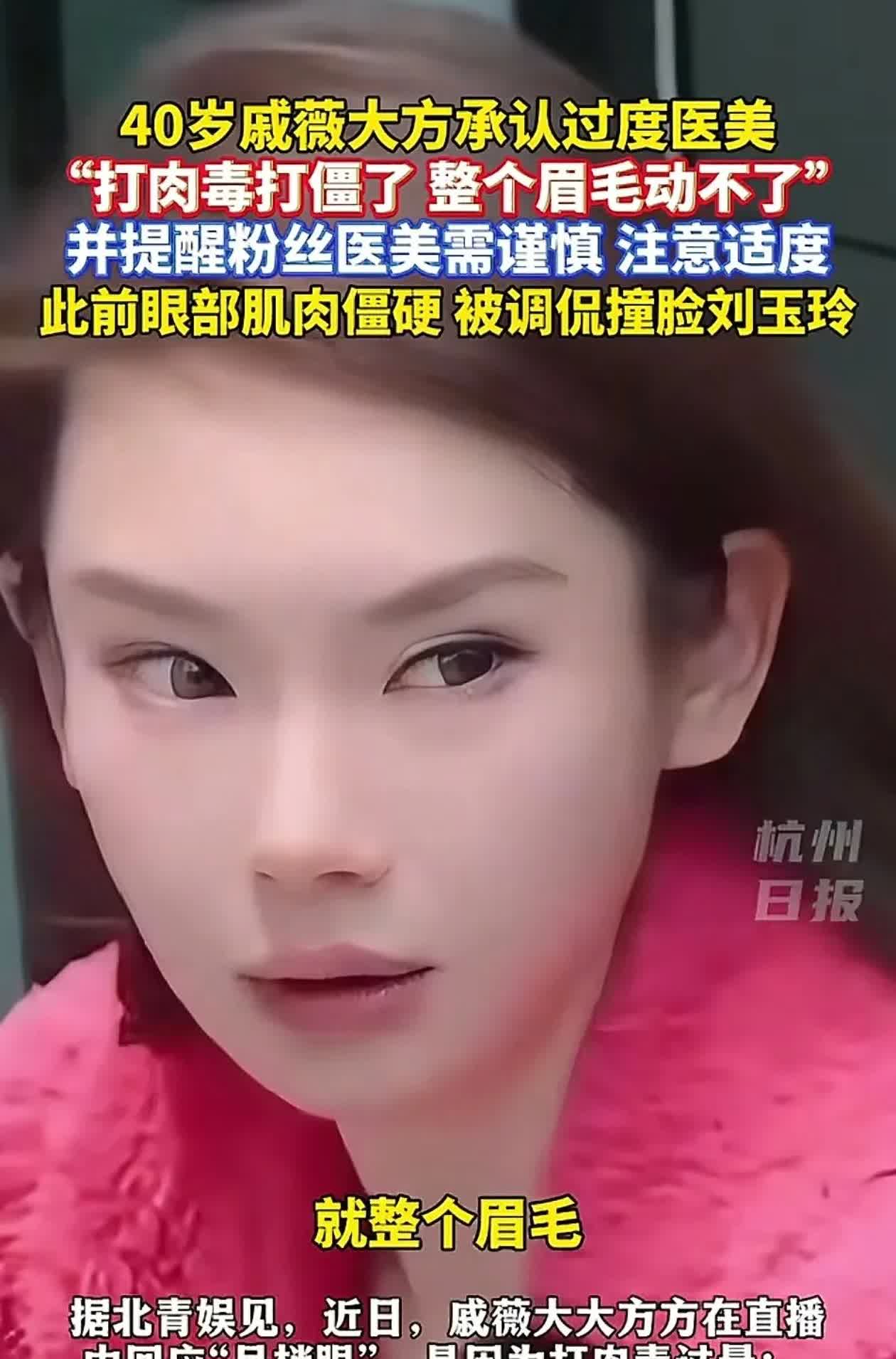 戚薇回应“吊梢眼”：打肉毒打僵了，我查了一下什么是肉毒：它一种被严格