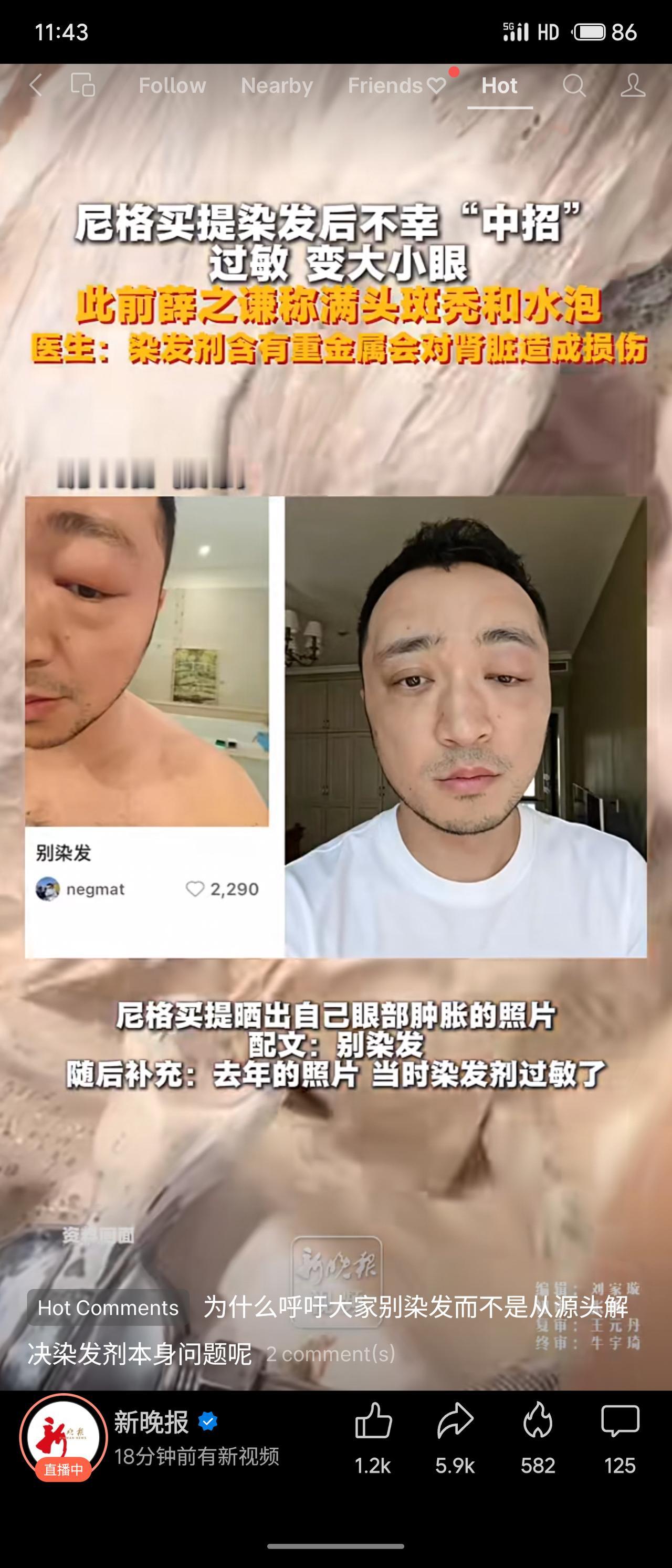 尼格买提因染发过敏导致眼部肿胀、大小眼，薛之谦也曾出现满头斑秃和水泡。医生提醒，