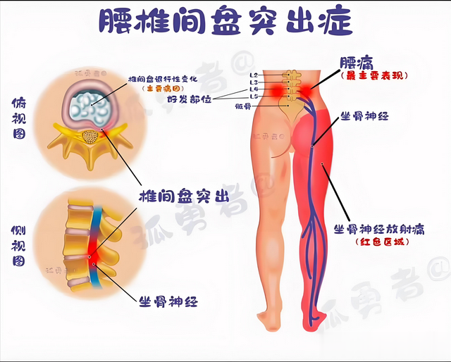 腰突, 如果没有这4个症状, 就可以把心放在肚子里