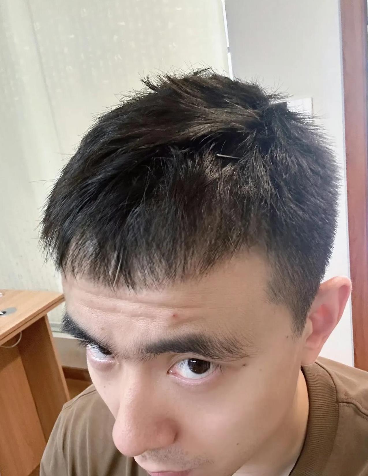 赵继伟不容易啊！赵继伟对嗓子进行针灸治疗，不仅扎头，还扎喉，这看着都疼！上赛