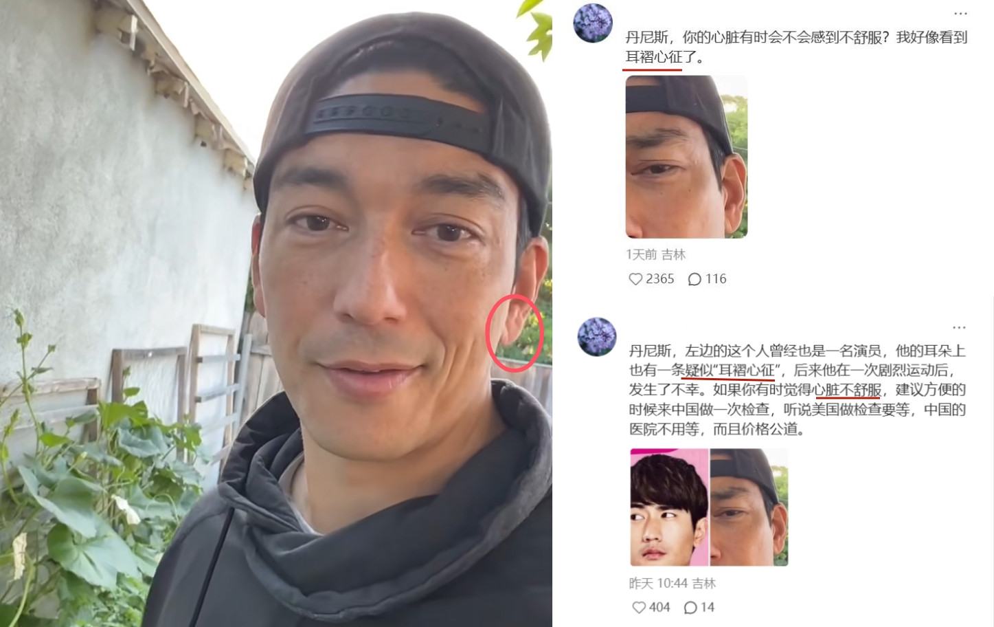 43岁男星耳垂疑似“耳褶心征”，网友刷屏：快去查心脏
