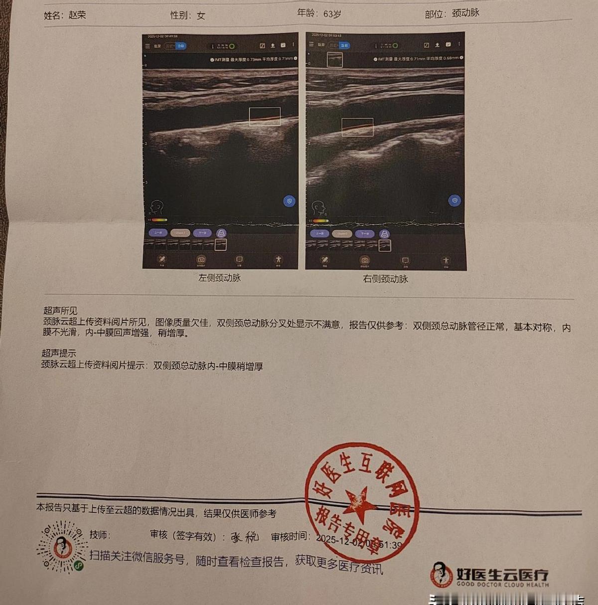 刚做完体检简直吓出一身冷汗，一周时间颈动脉斑块就能从0.6mm涨到0.73mm？