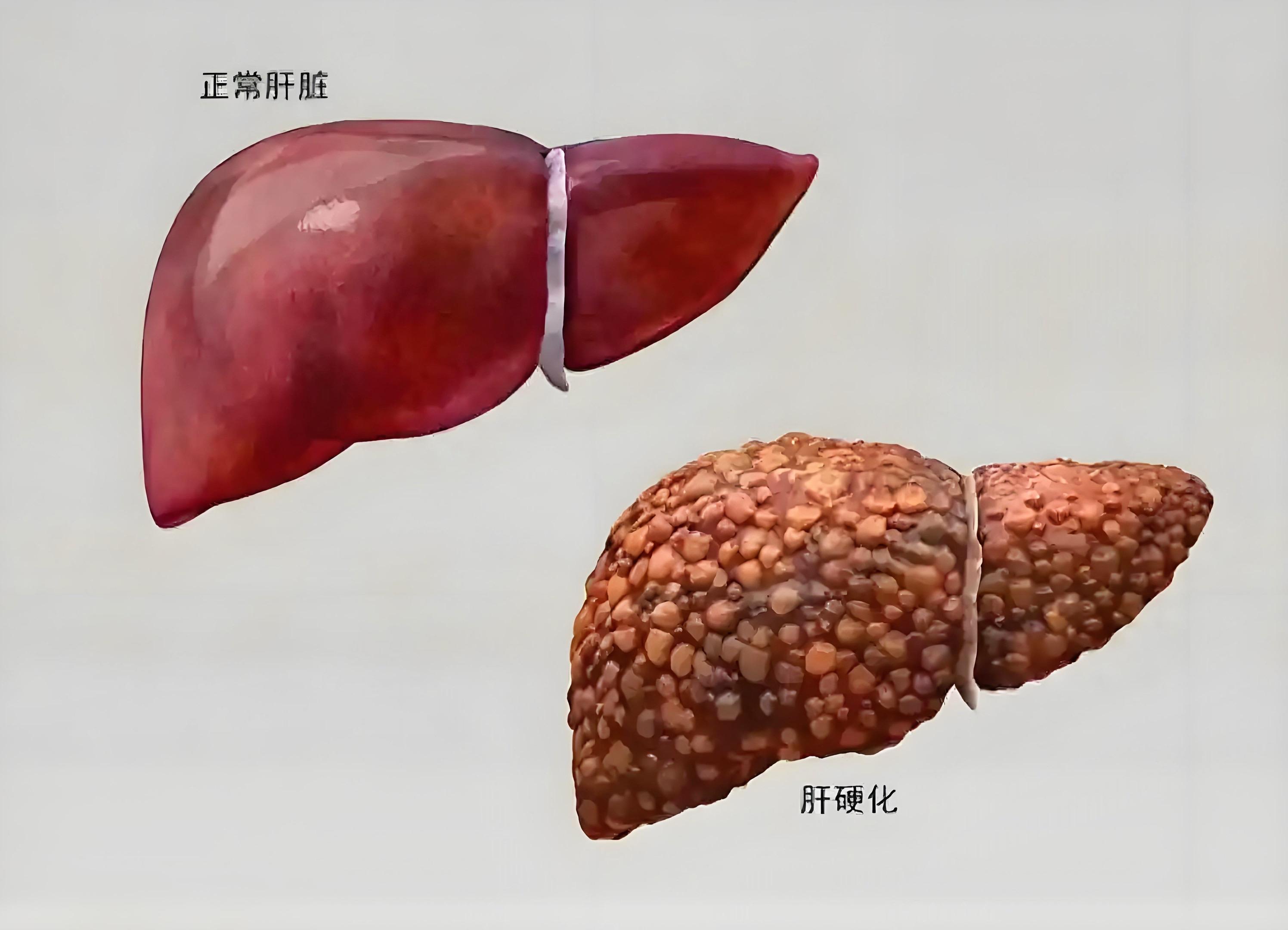 肝炎怎样转变肝硬化。肝炎进展到肝硬化的话一般有两种过程，一种就是反复的...