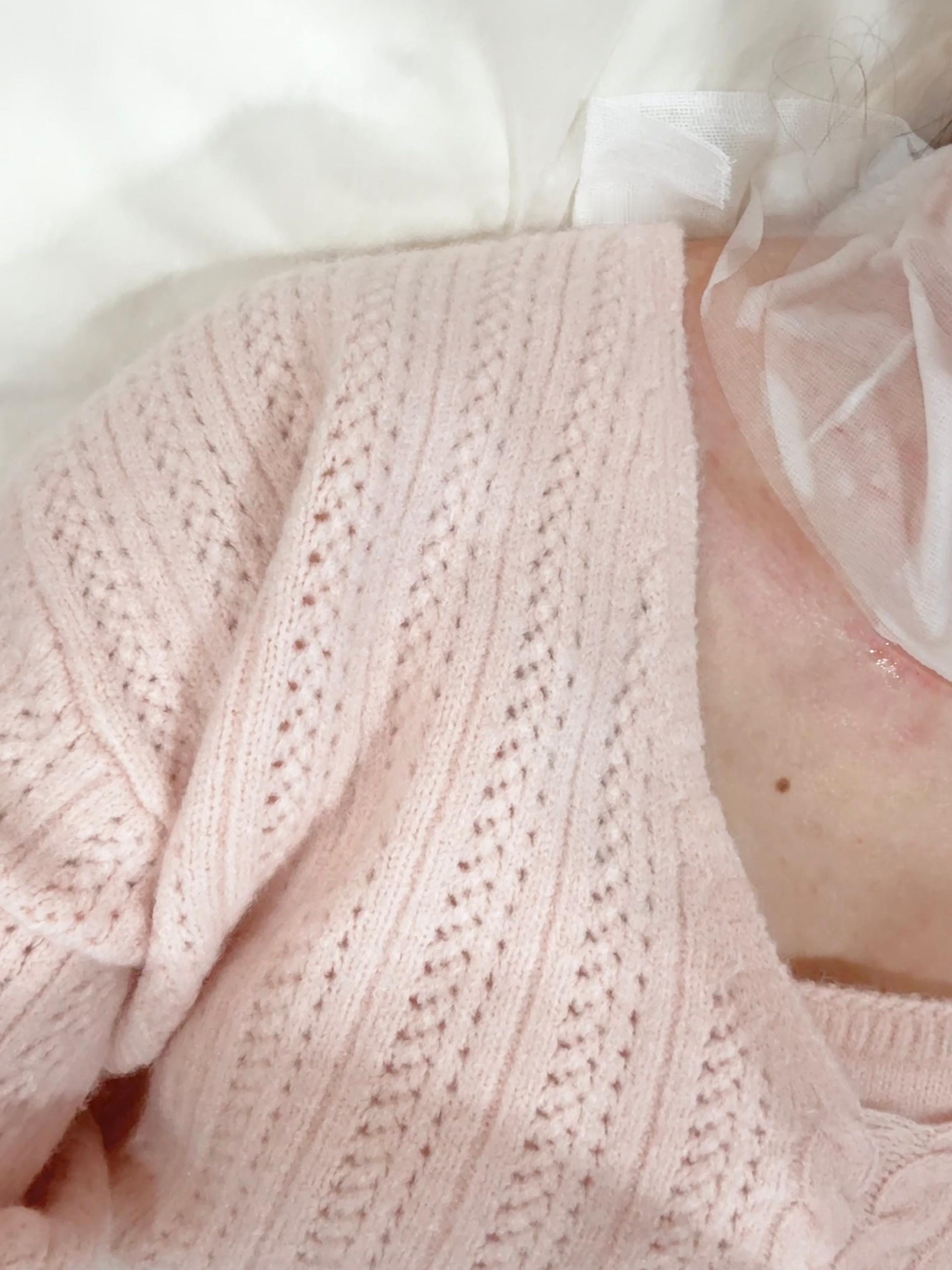 打了颈纹瘦肩水光过两天去打卧蚕感觉打颈纹好痛…医生说因为我皮肤太紧了而且