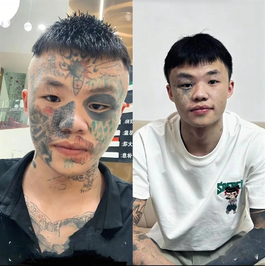 广东，纹面男孩夏朝勇为了洗掉年少时的纹身，已经做了三次激光清洗，再洗两次就能完全