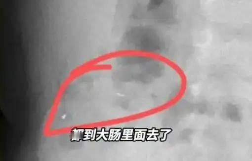 贵阳的刘女士1岁5个月大的儿子不小心把金锁上三个铃铛吞下了。吃进肚子里会