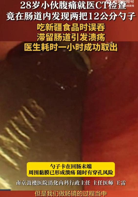 南京一位28岁小伙因为肚子疼去医院检查，一查把医生都吓了一跳，他的肠道里竟然藏着