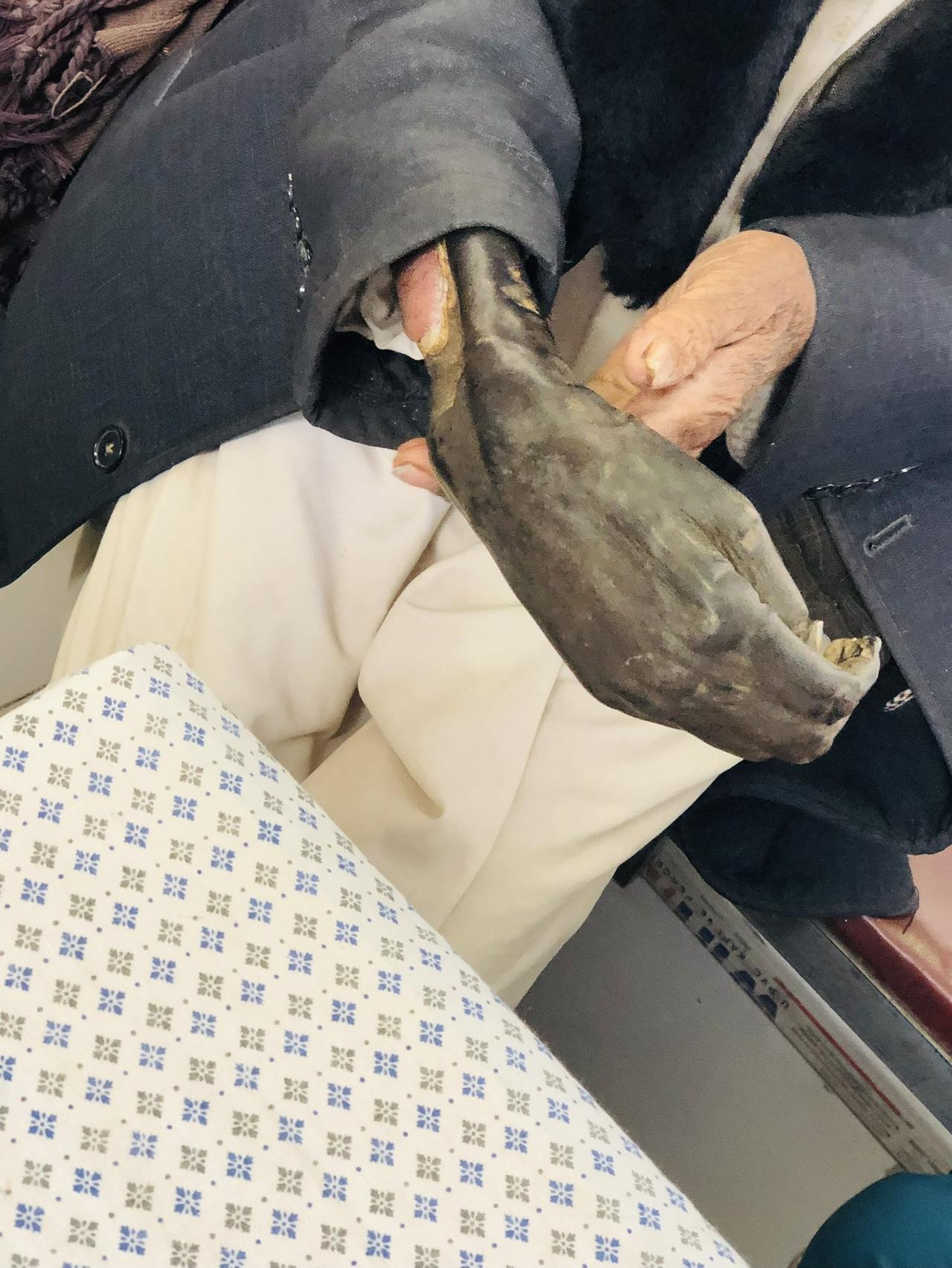 一名44岁阿拉伯男子因轻微身体疼痛被庸医非医务人员动脉内注射止痛药，导致急性肢体