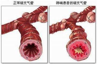 专家讲解: 支气管炎的症状、诱因与治疗方法
