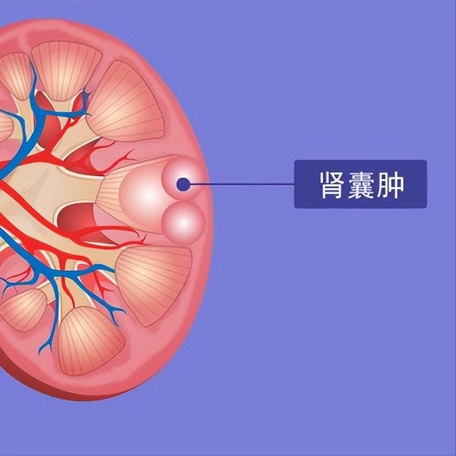 肾囊肿除了补肾, 还要祛湿热, 六味地黄丸配两味药, 加速消除囊肿