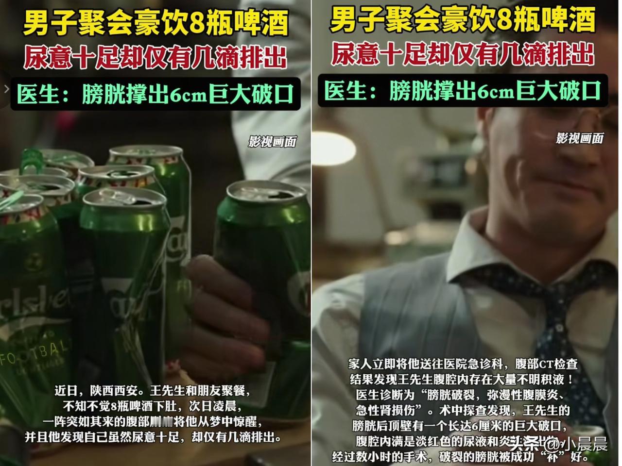 “喝8瓶啤酒没上厕所，膀胱直接裂了6厘米大口子！”陕西王先生这事儿，真给