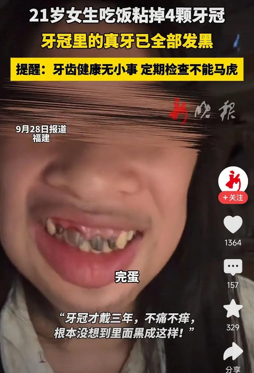 21岁女生吃饭粘掉4颗牙冠，牙冠里的真牙已全部发黑！网友表示：金属烤瓷牙就是