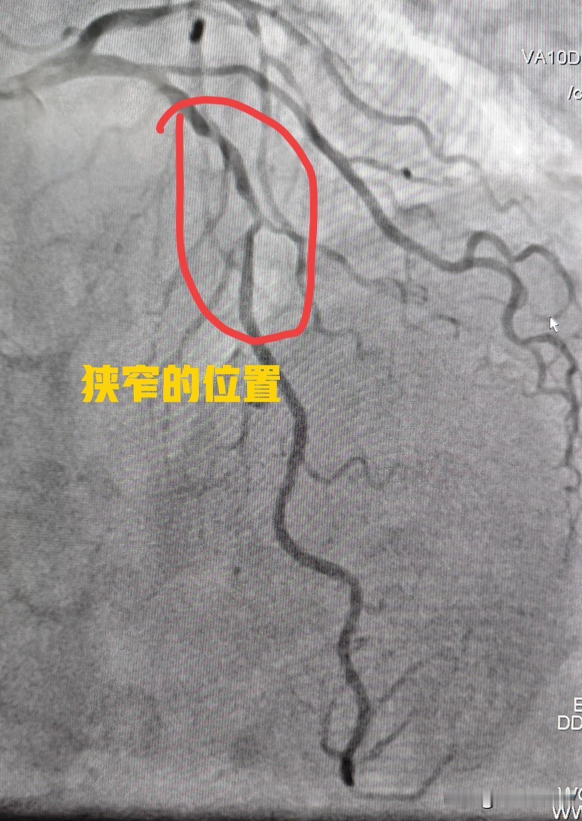 78岁老人冠心病药物保守治疗。今天给一个78岁老年女性的冠心病患者做了心脏造影