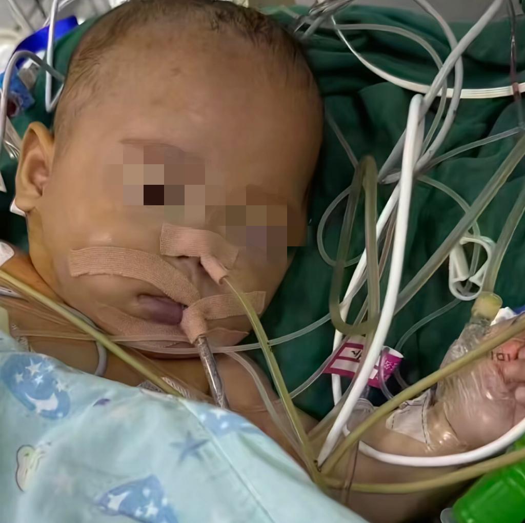 一个早产一个月的小婴儿，好不容易熬过了最脆弱的阶段，却在5个月大的时候因手术而去