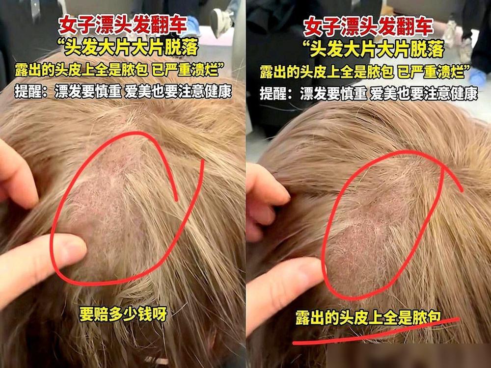 盯着那张上海姑娘烂掉的头皮看，我后脑勺都跟着一阵阵发紧。这不是翻车，这是把自