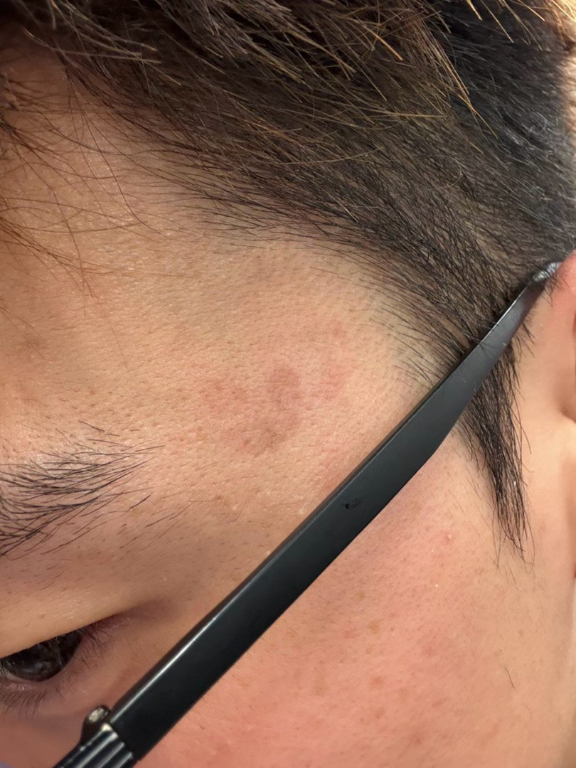 因为摄咖担心失眠最近使用清凉油物理提神涂了三天发现敏感肌已经淤青了[？？？]​​