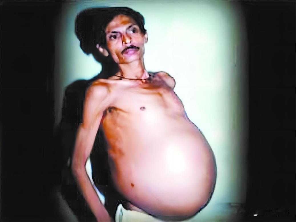 1999年，印度一男子因腹痛难忍被送到医院，然而，医生打开他巨大的肚子后，却被眼